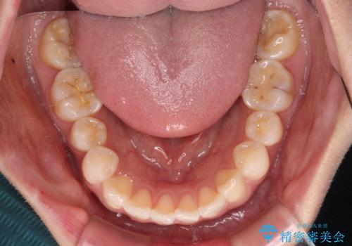 前歯のデコボコと口元の膨らみを治したい ワイヤー装置での非抜歯矯正の治療前