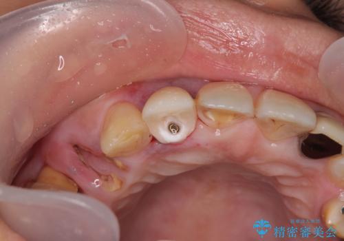 放置した破折歯 即時・早期のインプラント埋入による補綴治療の治療中