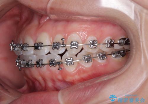 【モニター】マウスピース矯正が煩わしい ワイヤー装置での非抜歯矯正の治療中