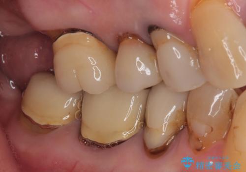食事が取れないほどの激痛 奥歯のインプラント治療の治療中