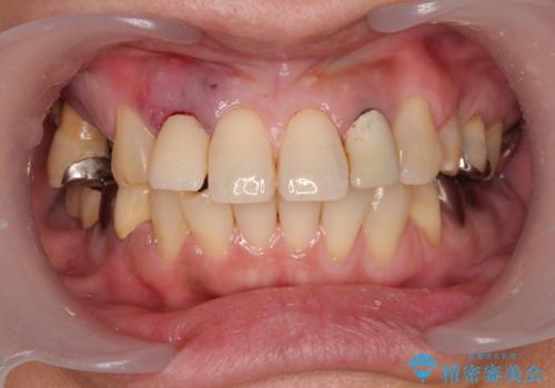 放置した破折歯 即時・早期のインプラント埋入による補綴治療の治療中