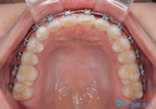 【モニター】マウスピース矯正が煩わしい ワイヤー装置での非抜歯矯正の治療中