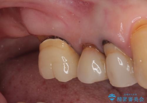 食事が取れないほどの激痛 奥歯のインプラント治療の治療中