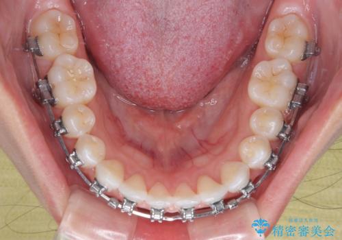 【モニター】マウスピース矯正が煩わしい ワイヤー装置での非抜歯矯正の治療中
