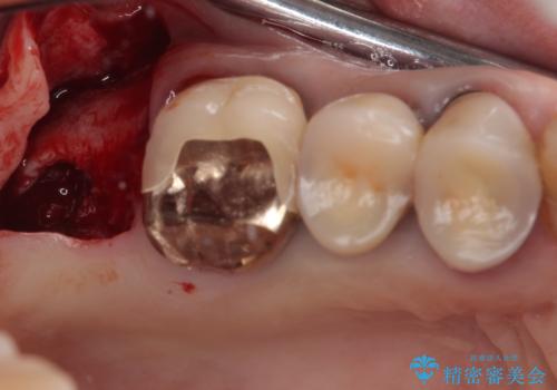 食事が取れないほどの激痛 奥歯のインプラント治療の治療中