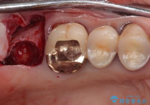 食事が取れないほどの激痛 奥歯のインプラント治療の治療後