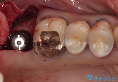 食事が取れないほどの激痛 奥歯のインプラント治療の治療前