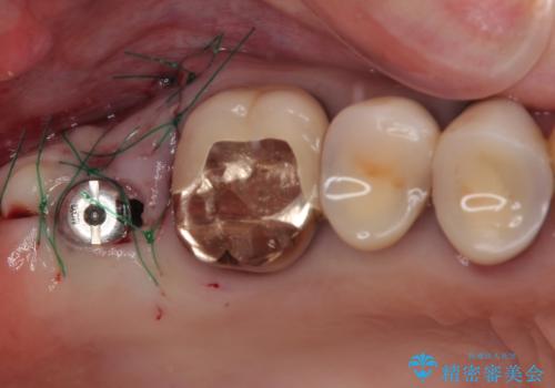 食事が取れないほどの激痛 奥歯のインプラント治療の治療中