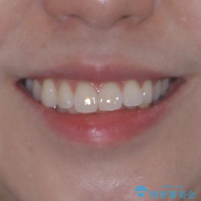 気になる前歯を短期間で治す インビザライン・モデレートでの矯正治療の治療前(顔貌)