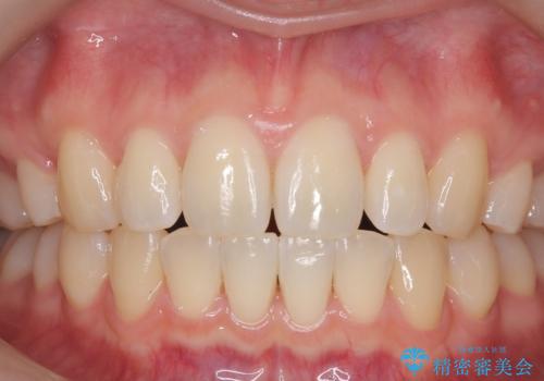 矯正治療が終わったら、次はホワイトニングで仕上げ!の治療前
