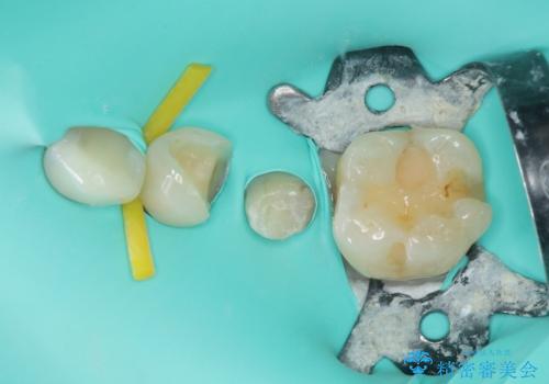 詰め物が外れかけてるのでやり替えたい セラミックインレー修復・フルジルコニアクラウンの治療中