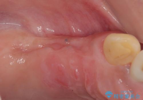 放置した破折歯 即時・早期のインプラント埋入による補綴治療の治療中