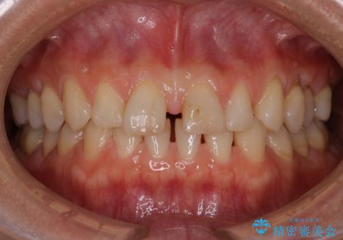 【審美装置】すきっ歯をワイヤー装置で治したいの症例 治療前