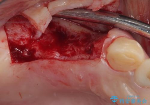 放置した破折歯 即時・早期のインプラント埋入による補綴治療の治療後
