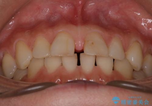 【審美装置】すきっ歯をワイヤー装置で治したいの治療前
