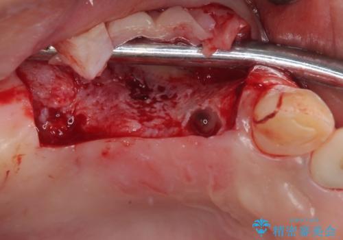 放置した破折歯 即時・早期のインプラント埋入による補綴治療の治療前