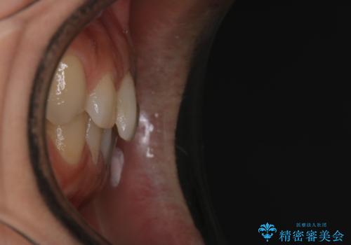 【審美装置】すきっ歯をワイヤー装置で治したいの治療前