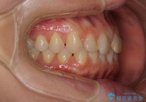 【審美装置】すきっ歯をワイヤー装置で治したいの治療前