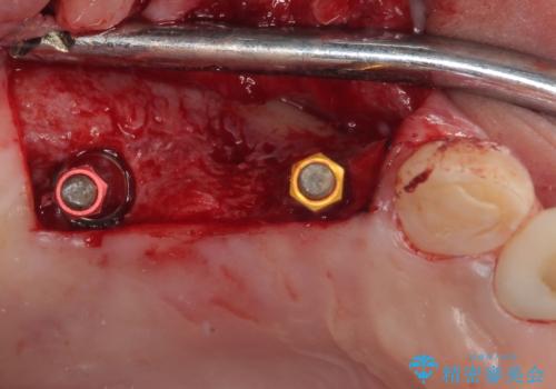 放置した破折歯 即時・早期のインプラント埋入による補綴治療の治療中