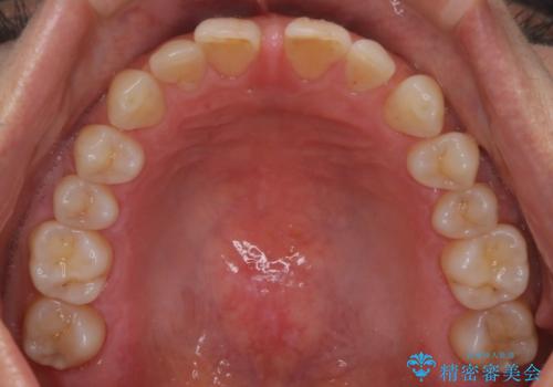 【審美装置】すきっ歯をワイヤー装置で治したいの治療前