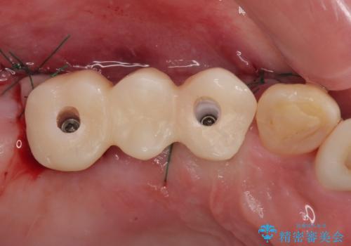 放置した破折歯 即時・早期のインプラント埋入による補綴治療の治療中