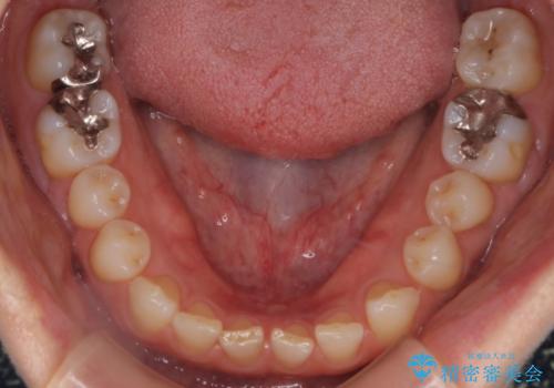 【審美装置】すきっ歯をワイヤー装置で治したいの治療前
