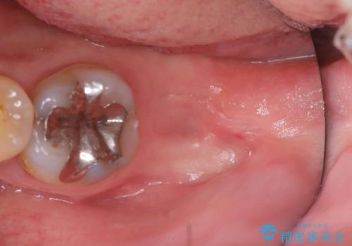 エンドペリオ病変と虫歯を同時に改善したインプラント・セラミック治療症例の治療中