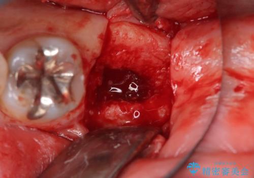 エンドペリオ病変と虫歯を同時に改善したインプラント・セラミック治療症例の治療中