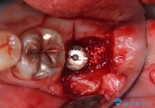 エンドペリオ病変と虫歯を同時に改善したインプラント・セラミック治療症例の治療中