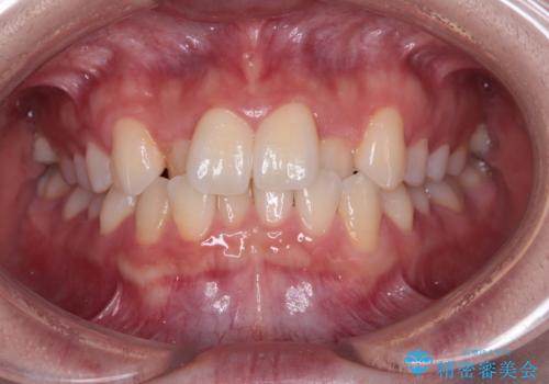 前歯のクロスバイト 裏側に隠れた歯をワイヤー装置で短期間治療