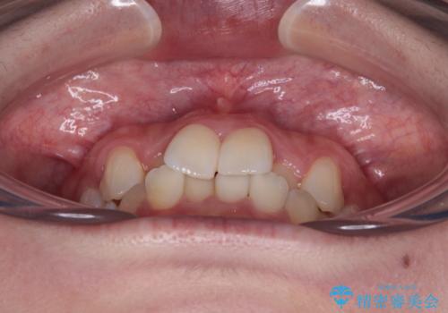 前歯のクロスバイト 裏側に隠れた歯をワイヤー装置で短期間治療の治療前