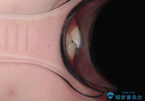 前歯のクロスバイト 裏側に隠れた歯をワイヤー装置で短期間治療の治療前