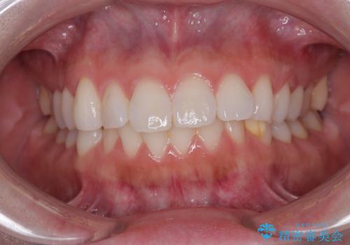 気になる前歯を短期間で治す インビザライン・モデレートでの矯正治療の治療前