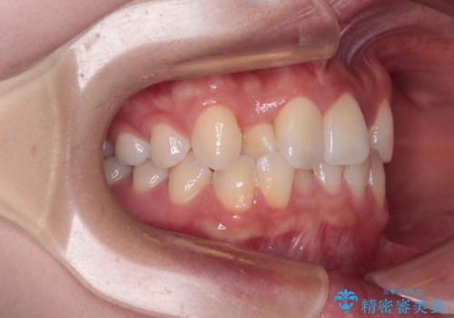前歯のクロスバイト 裏側に隠れた歯をワイヤー装置で短期間治療の治療前