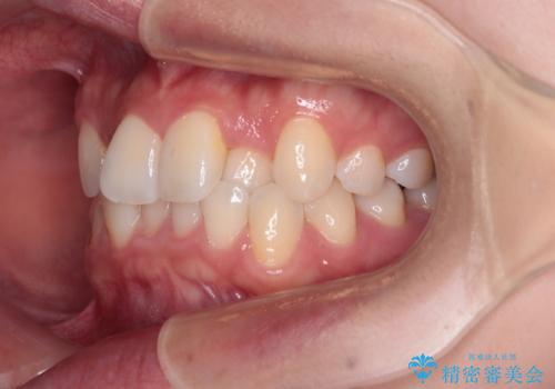 前歯のクロスバイト 裏側に隠れた歯をワイヤー装置で短期間治療の治療前