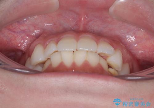 気になる前歯を短期間で治す インビザライン・モデレートでの矯正治療の治療前