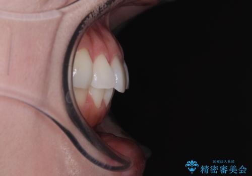 気になる前歯を短期間で治す インビザライン・モデレートでの矯正治療の治療前