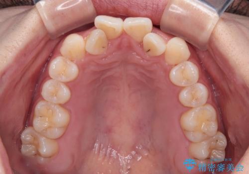 前歯のクロスバイト 裏側に隠れた歯をワイヤー装置で短期間治療の治療前