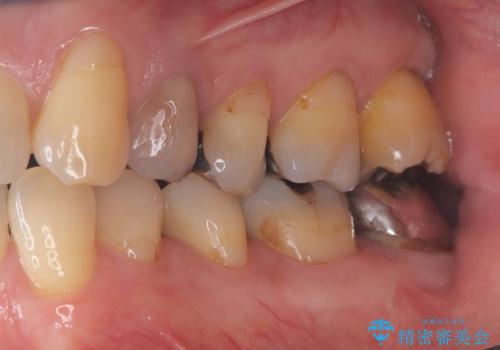 エンドペリオ病変と虫歯を同時に改善したインプラント・セラミック治療症例の治療前
