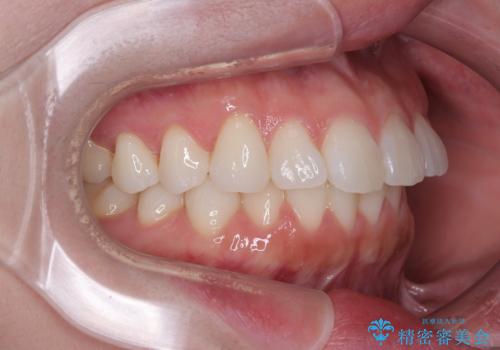 気になる前歯を短期間で治す インビザライン・モデレートでの矯正治療の治療前