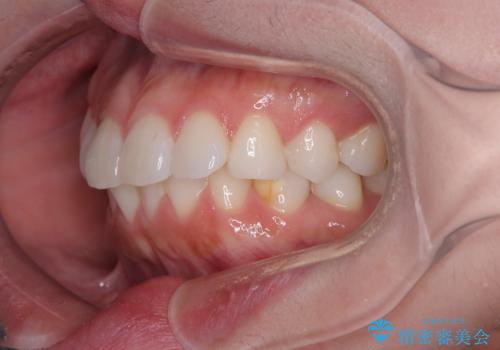 気になる前歯を短期間で治す インビザライン・モデレートでの矯正治療の治療前