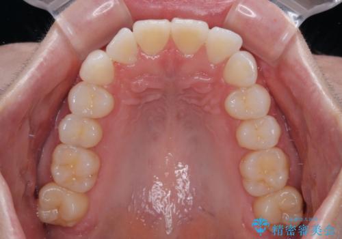 気になる前歯を短期間で治す インビザライン・モデレートでの矯正治療の治療前