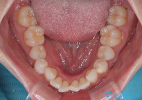 気になる前歯を短期間で治す インビザライン・モデレートでの矯正治療の治療前