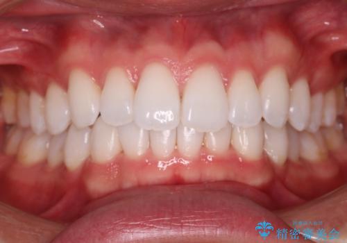 【インビザラインモニター】費用を抑えて歯並び改善!の症例 治療後
