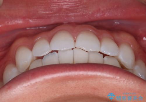 【インビザラインモニター】費用を抑えて歯並び改善!の治療後