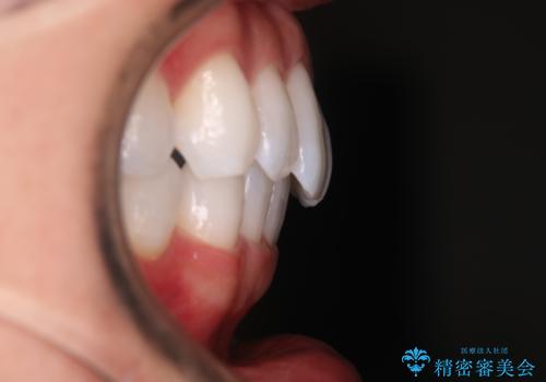 【インビザラインモニター】費用を抑えて歯並び改善!の治療後