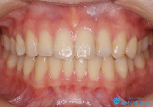 【非抜歯】インビザラインの短期治療の治療後
