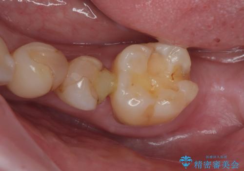 詰め物が外れかけてるのでやり替えたい セラミックインレー修復・フルジルコニアクラウンの症例 治療前