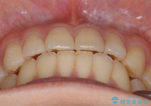 【非抜歯】インビザラインの短期治療の治療後