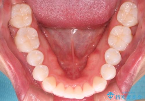 【インビザラインモニター】費用を抑えて歯並び改善!の治療後